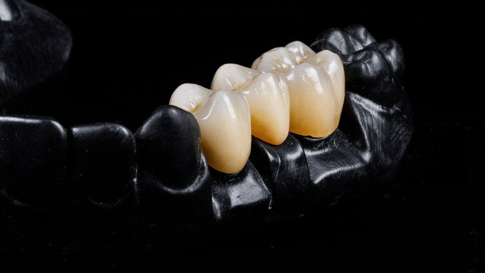 sloan dental studio_Service_zirconia-restorations