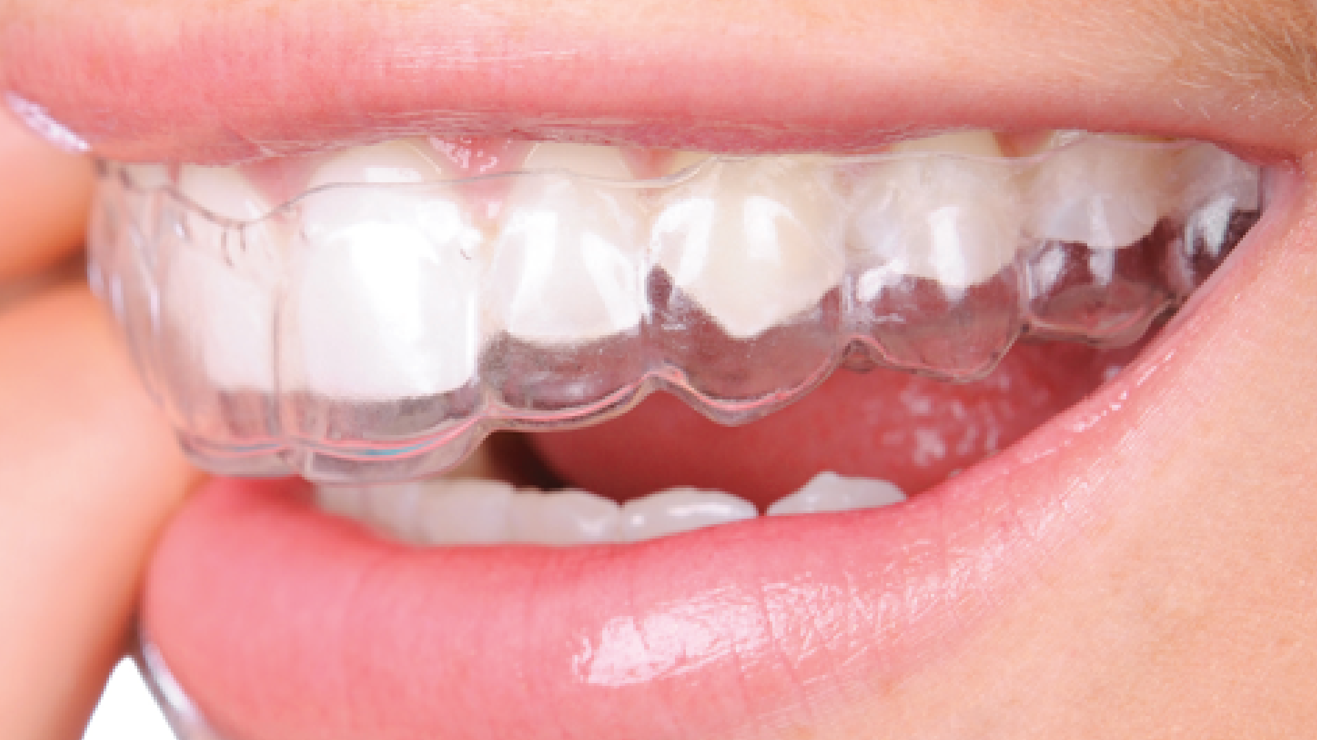 Clear Aligners